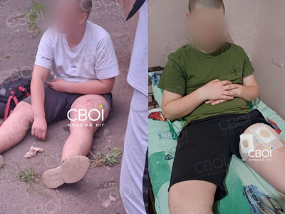 Дитині вистрелили в ногу на дитячому майданчику у Кривому Розі: медики дістали кулю