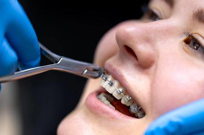 Як вибрати брекети: повний гід для дорослих і підлітків